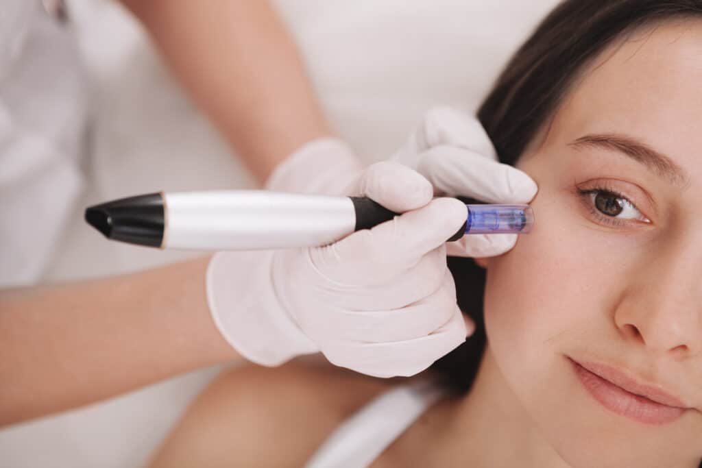 Woman receiving microneedling treatment for collagen production. Woman receiving microneedling treatment for collagen production.